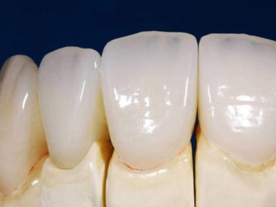 protese-dentaria-em-porcelana-pura-e-zircônia-diferença-1038x576